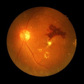 Diabetic Retinopathy