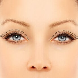 Blepharoplasty