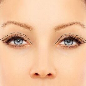 Blepharoplasty
