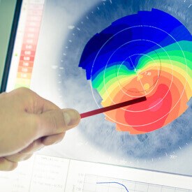 Keratoconus